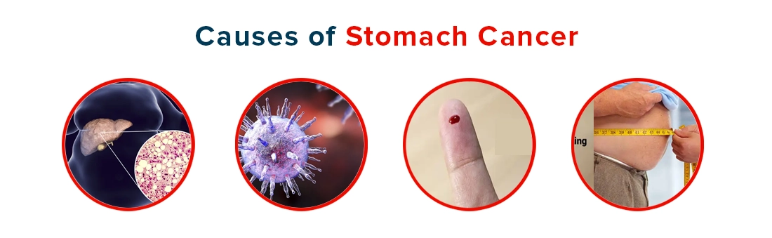 Causes of Stomach Cancer